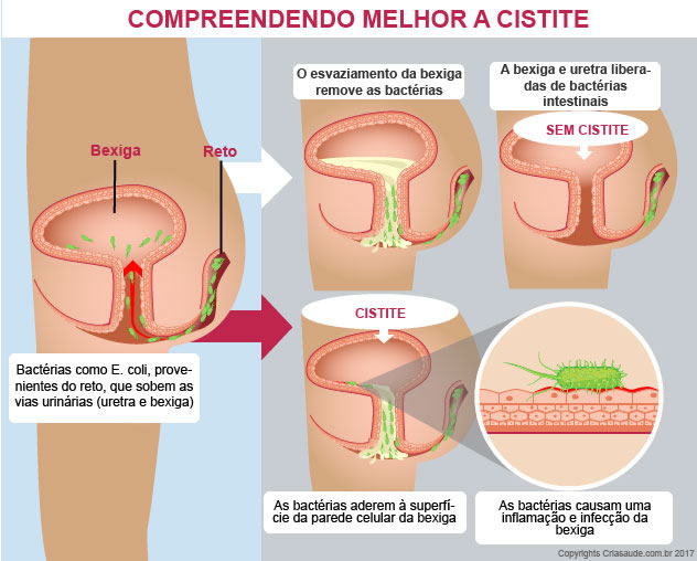 cistite-entender-pn-cysc-p-v-1-2