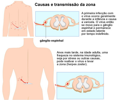Causas herpes zóster