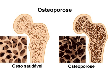 osteoporose-sintomas-criasaude