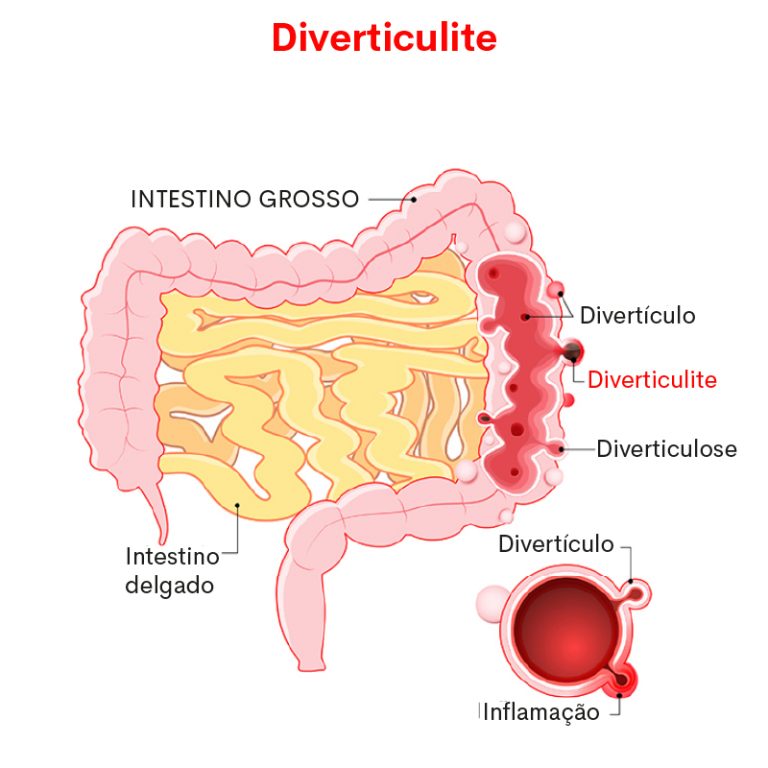 Diverticulite: sintomas & tratamentos | Criasaude